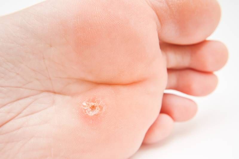 μυρμηγκιες