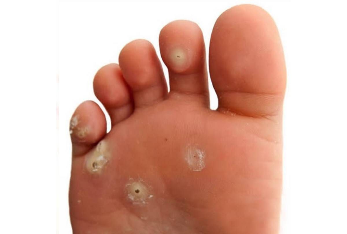 μυρμηγκιες αντιμετωπιση