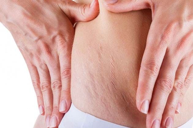 ουλες ραγαδες