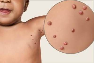 μολυσματικη τερμινθος