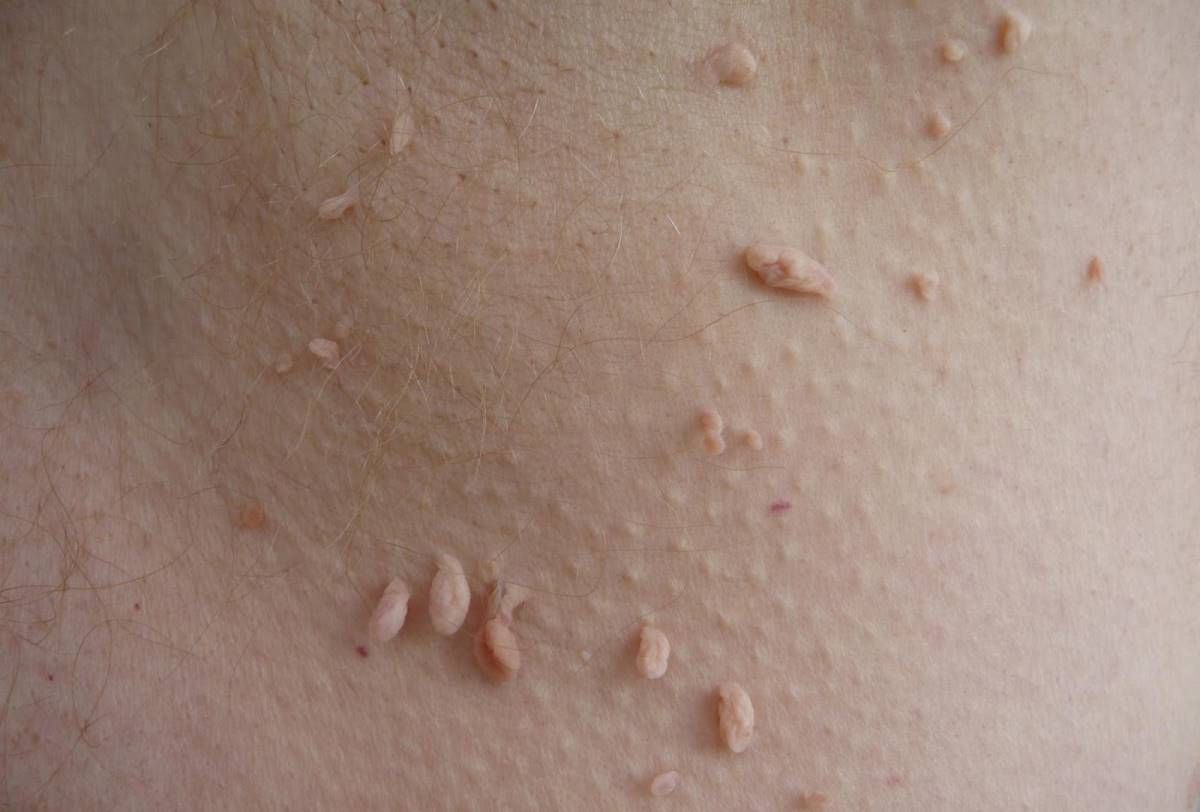 θηλωματα αντιμετωπιση