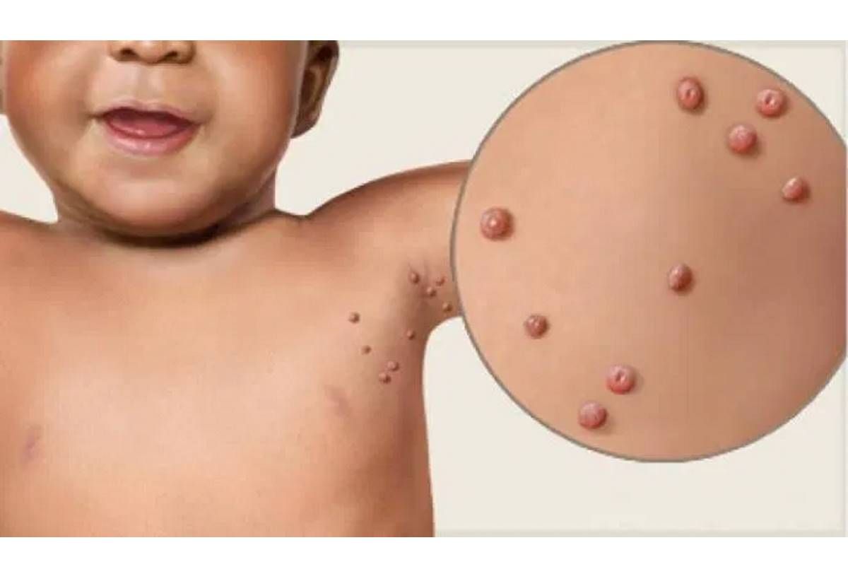 μολυσματικη τερμινθος αντιμετωπιση