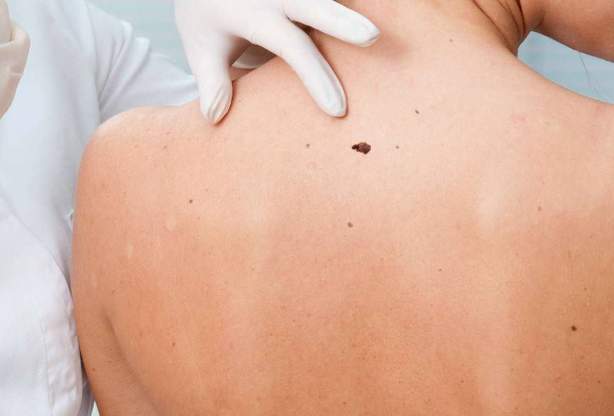 μελανωμα αντιμετωπιση