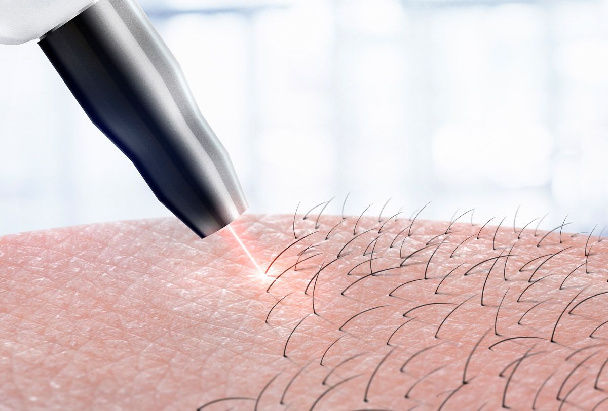 αποτριχωση laser alexandrite