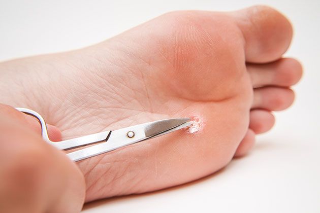 μυρμηγκιες αντιμετωπιση